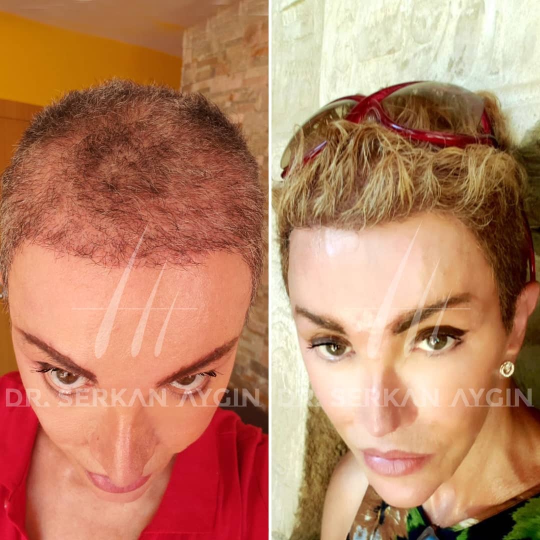 Haartransplantation Türkei Frauen vorher nachher