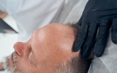 Haarausfall betrifft vor allem Männer ab 50: Was hilft gegen den Haarverlust? 
