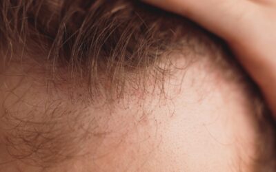 DHT und Haarausfall – welchen Zusammenhang gibt es?