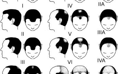 Hamilton Norwood Skala: Stufen des Haarausfalls