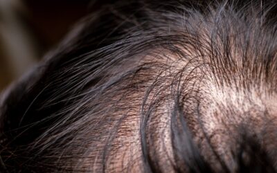 Dünnes Haar beim Mann: Genetische Alopezie 