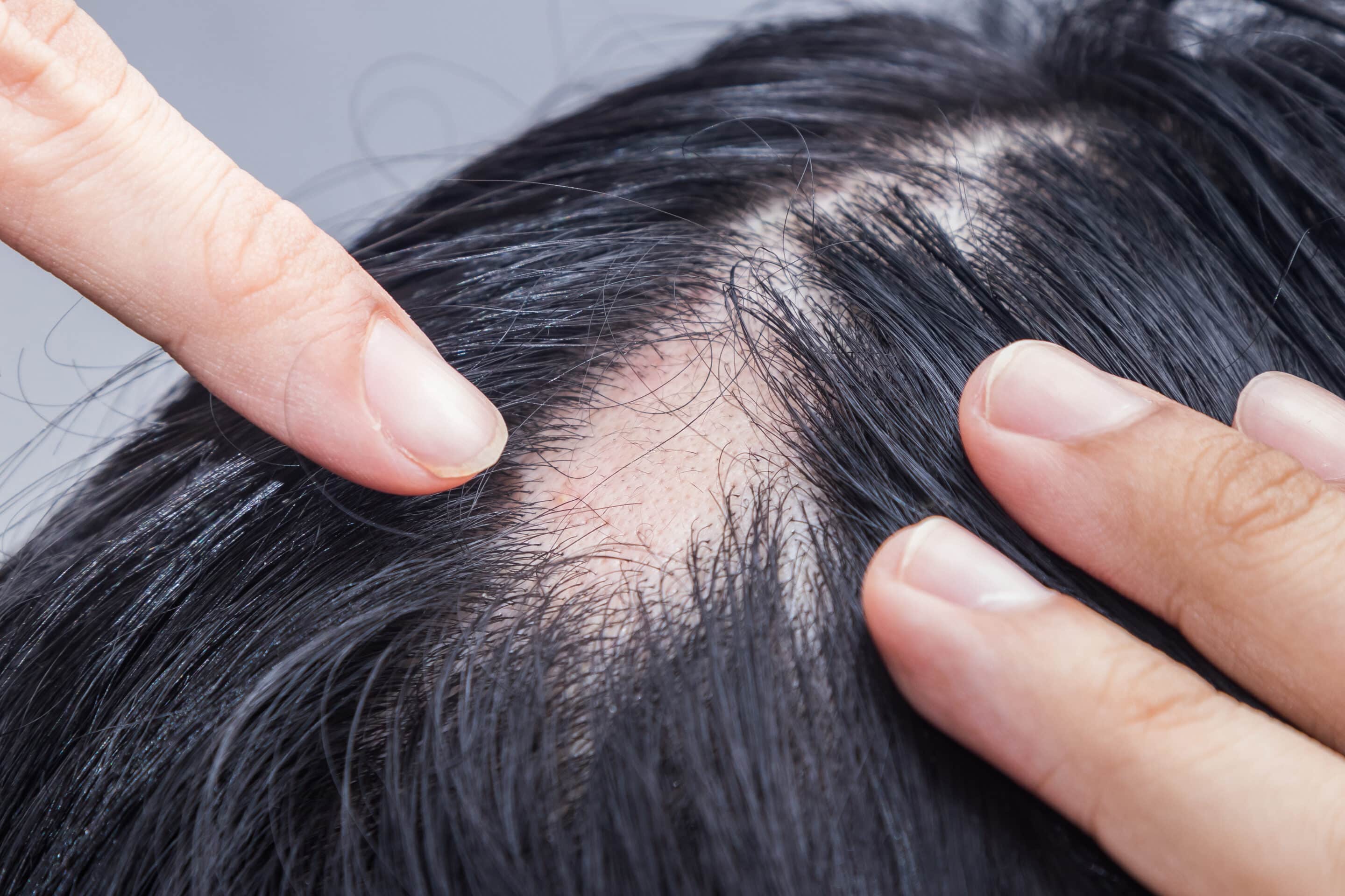 Ein Mann, der durch Stress kreisrunden Haarausfall hat, zeigt seinen Hinterkopf