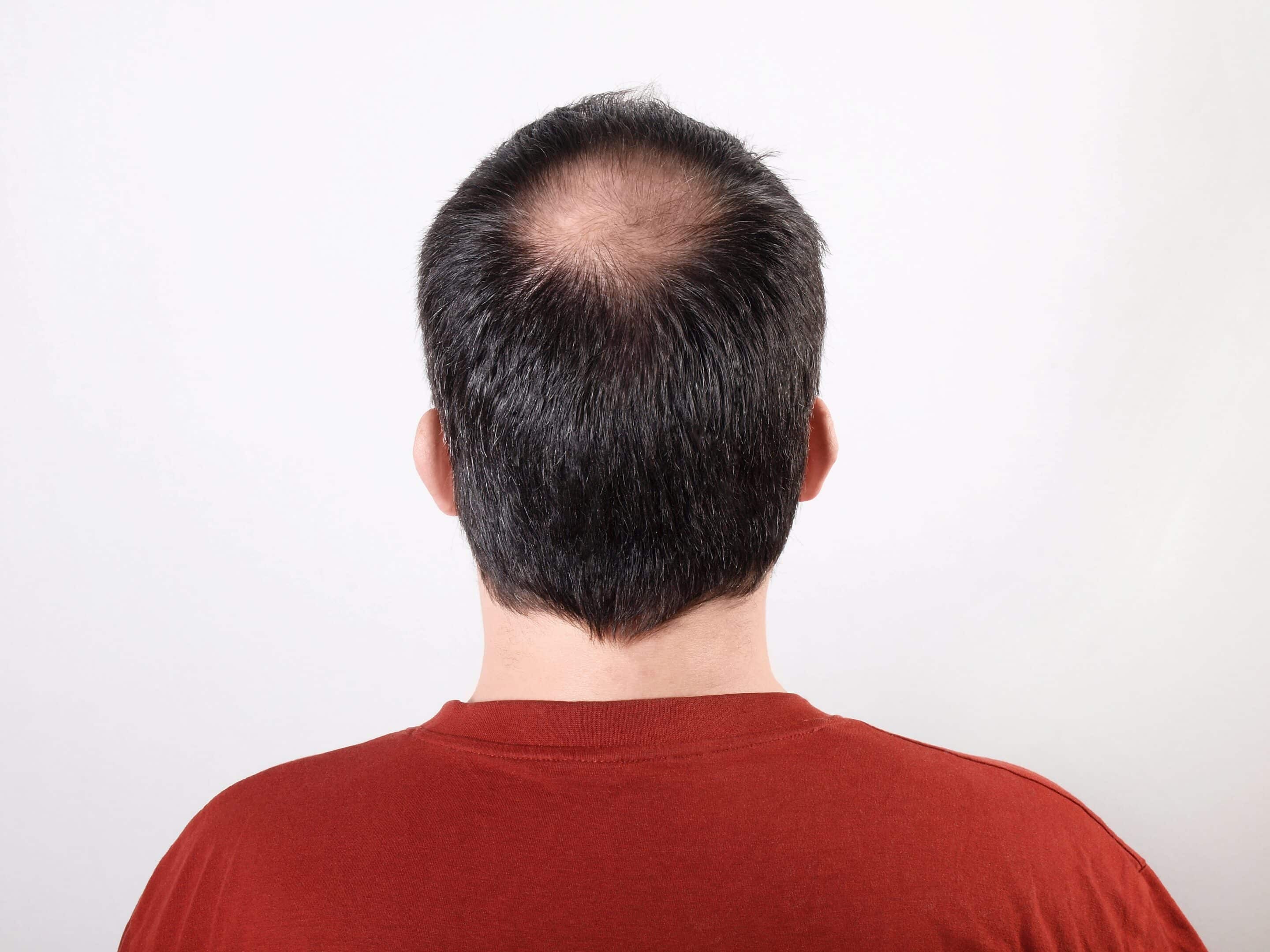Ein Patient zeigt seinen durch Stress entstandenen kreisrunden Haarausfall.