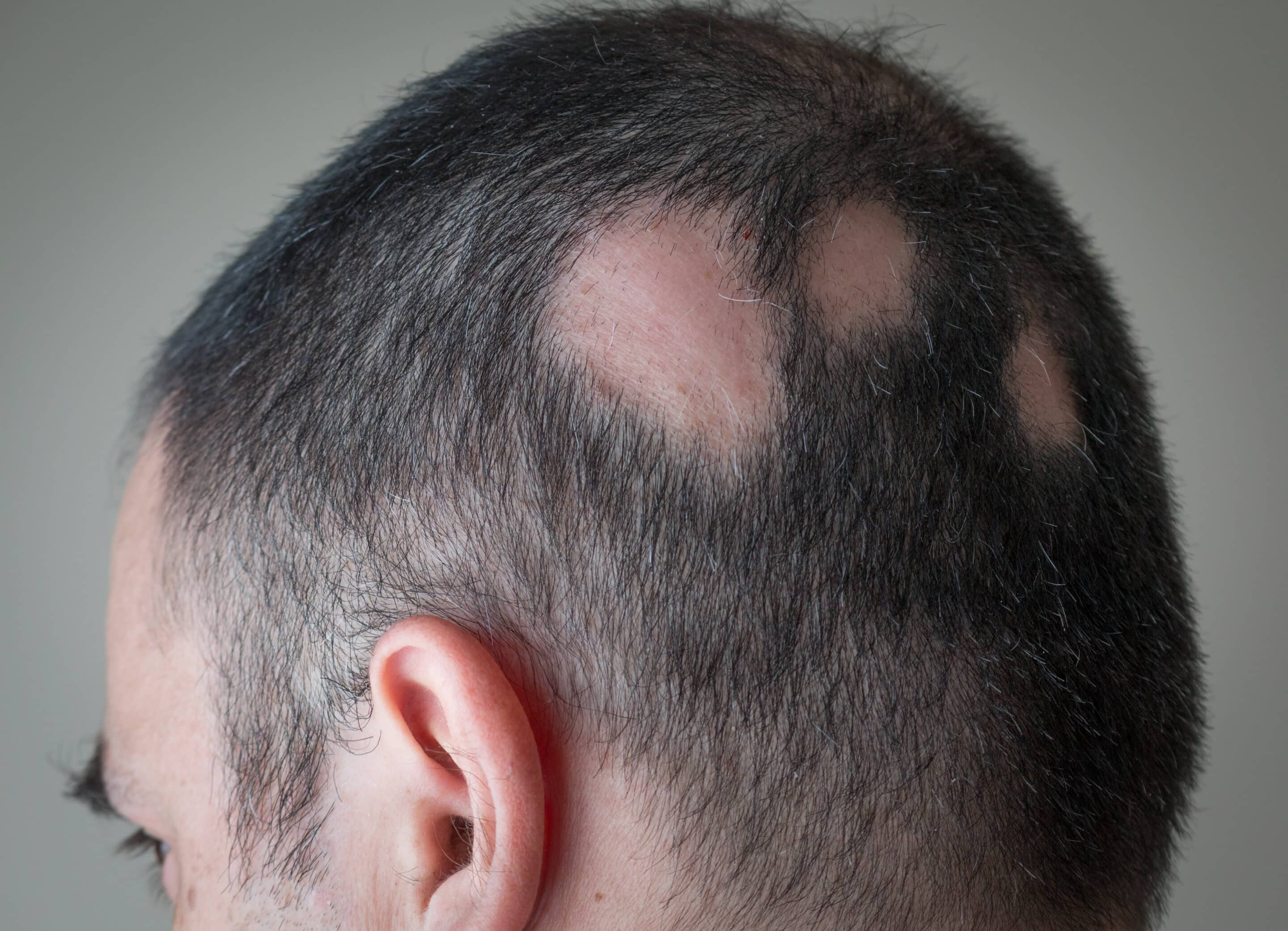 Ein Mann der durch Stress mit kreisrundem Haarausfall zu kämpfen hat