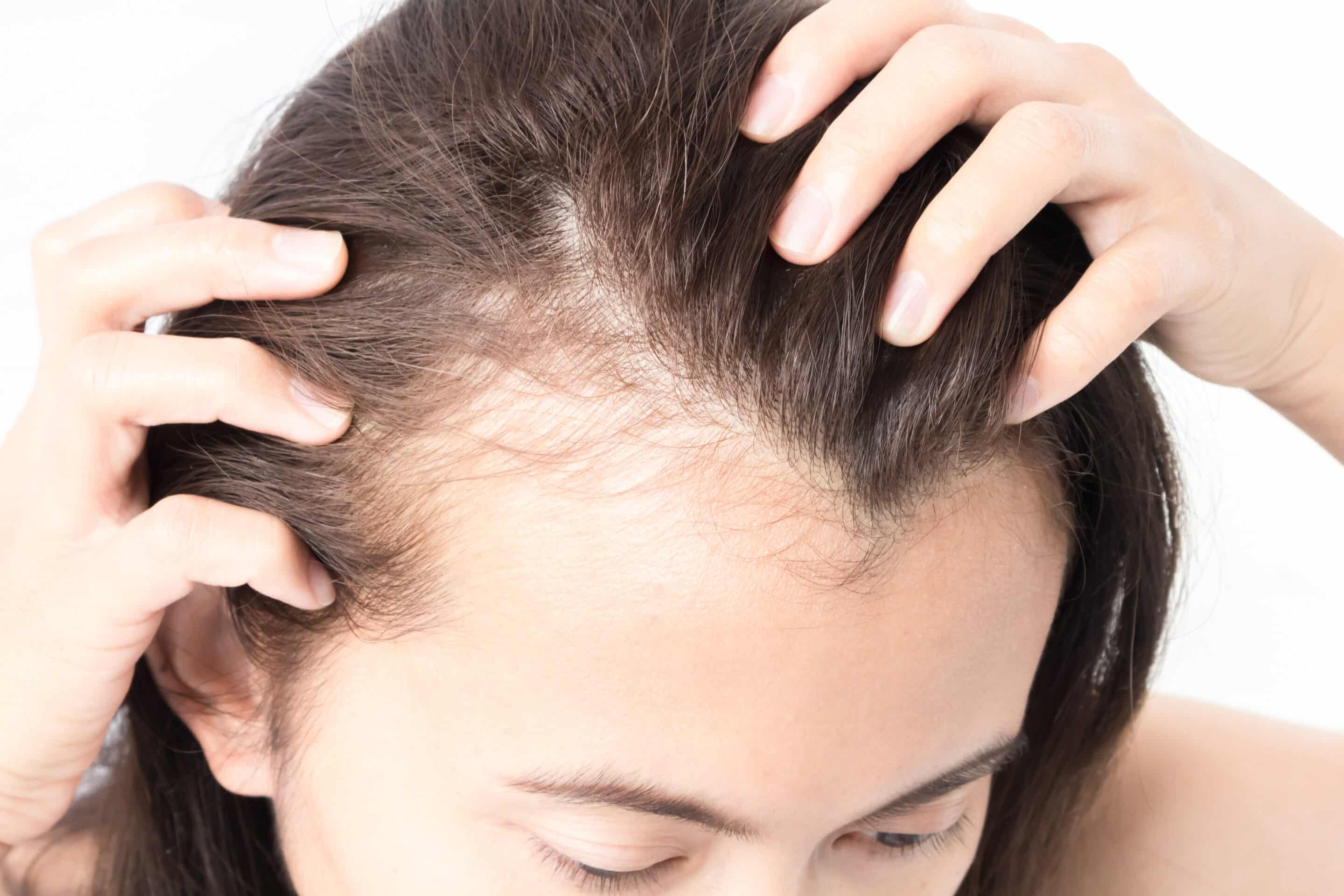 Eine Frau mit Haarausfall verwendet Priorin gegen ihre immer lichter werdenden Haare