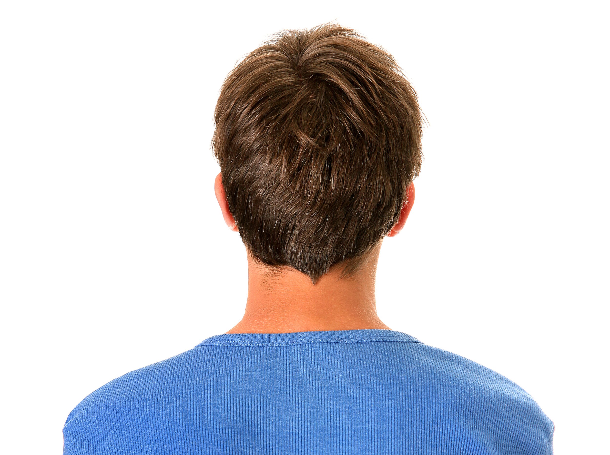 Ein Mann, der nach einer Haartransplantation Haarausfall hatte, zeigt seinen dichten Spenderbereich