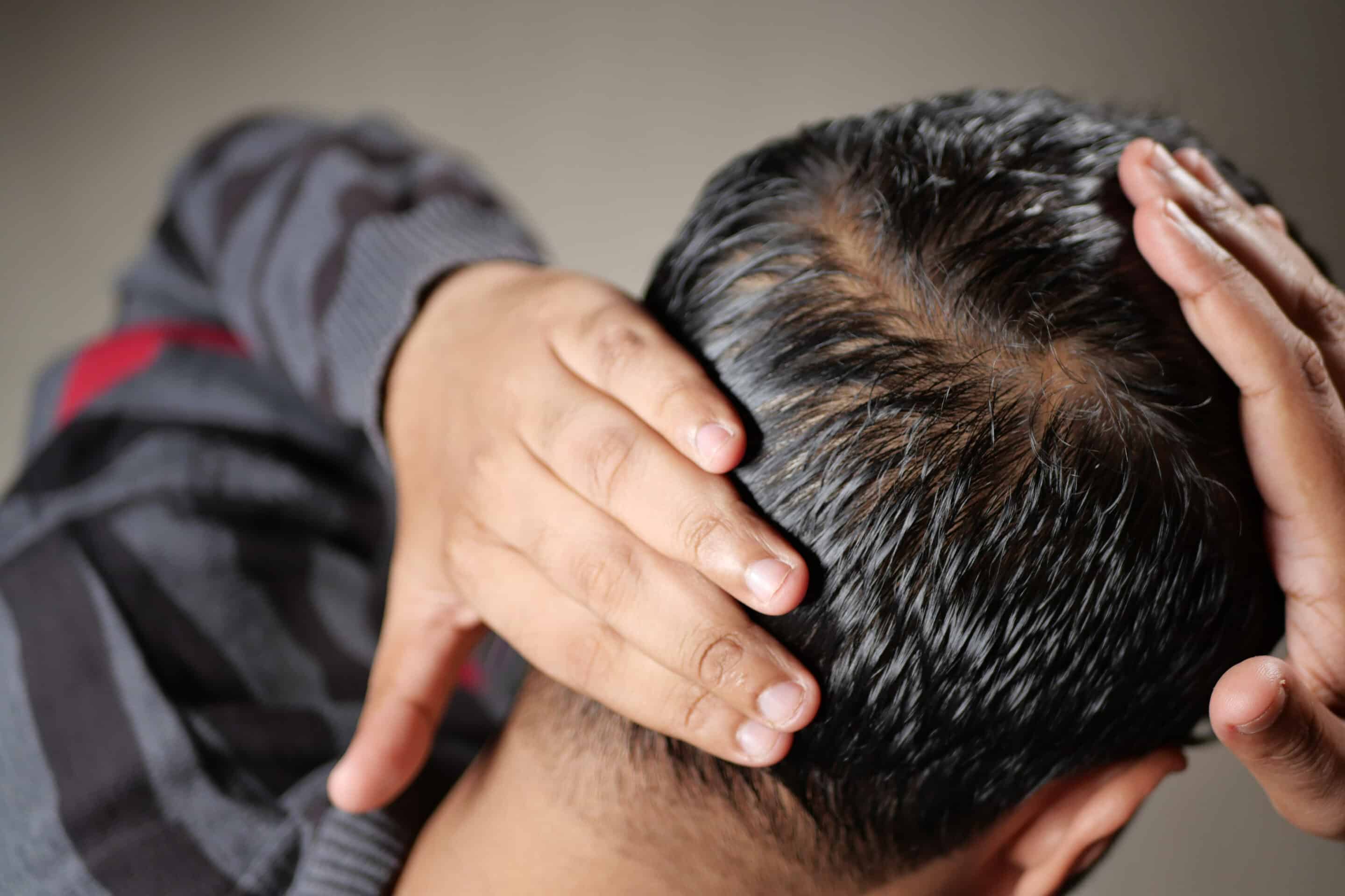 Ein Mann mit Haarausfall, der zur Vorbeugung Biotin einnimmt