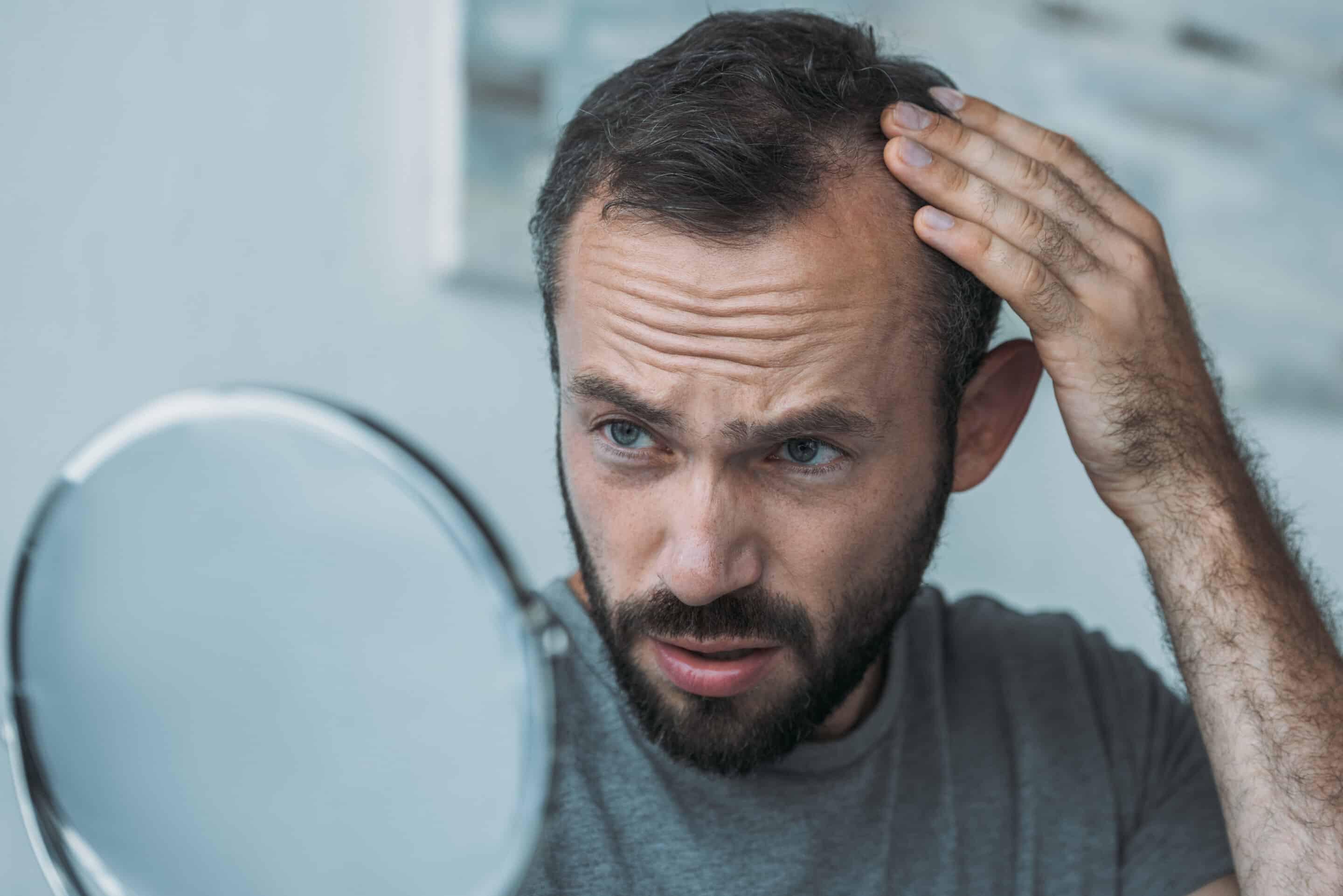 Ein Mann betrachtet seine Geheimratsecken vor dem Spiegel und benötigt eine Haartransplantation